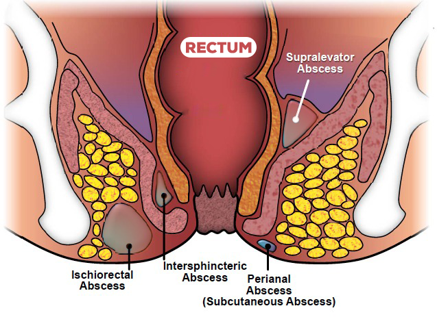 Types of Perianal Abscess