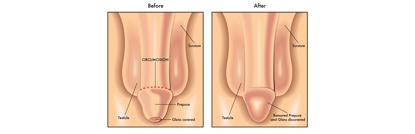 baby circumcision infection