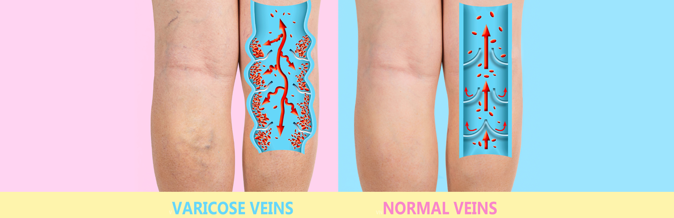 How to Prevent Worsening of Varicose Veins?