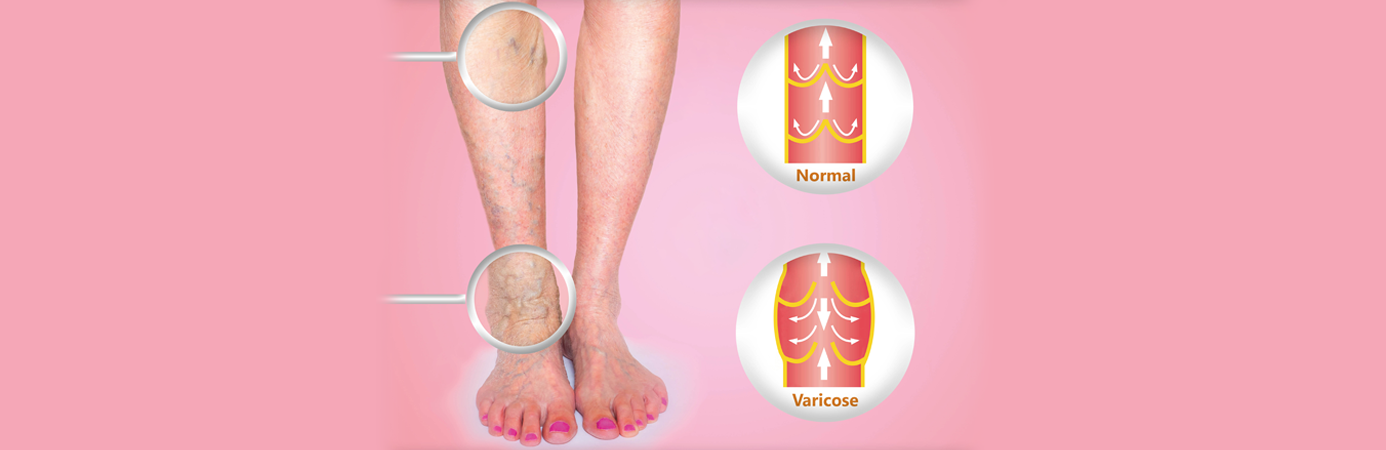 What Are The Main Causes of Varicose Veins?