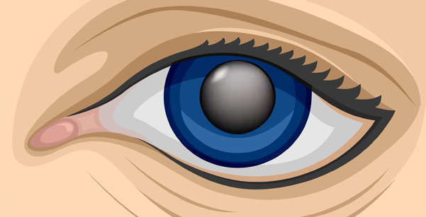 Congenital Cataracts