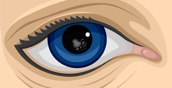 Posterior Cataracts