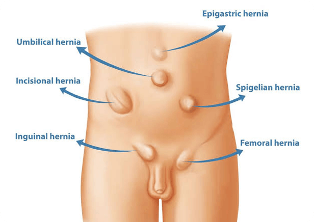 Types Of Hernai