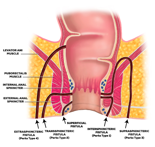 Types Of Fistula